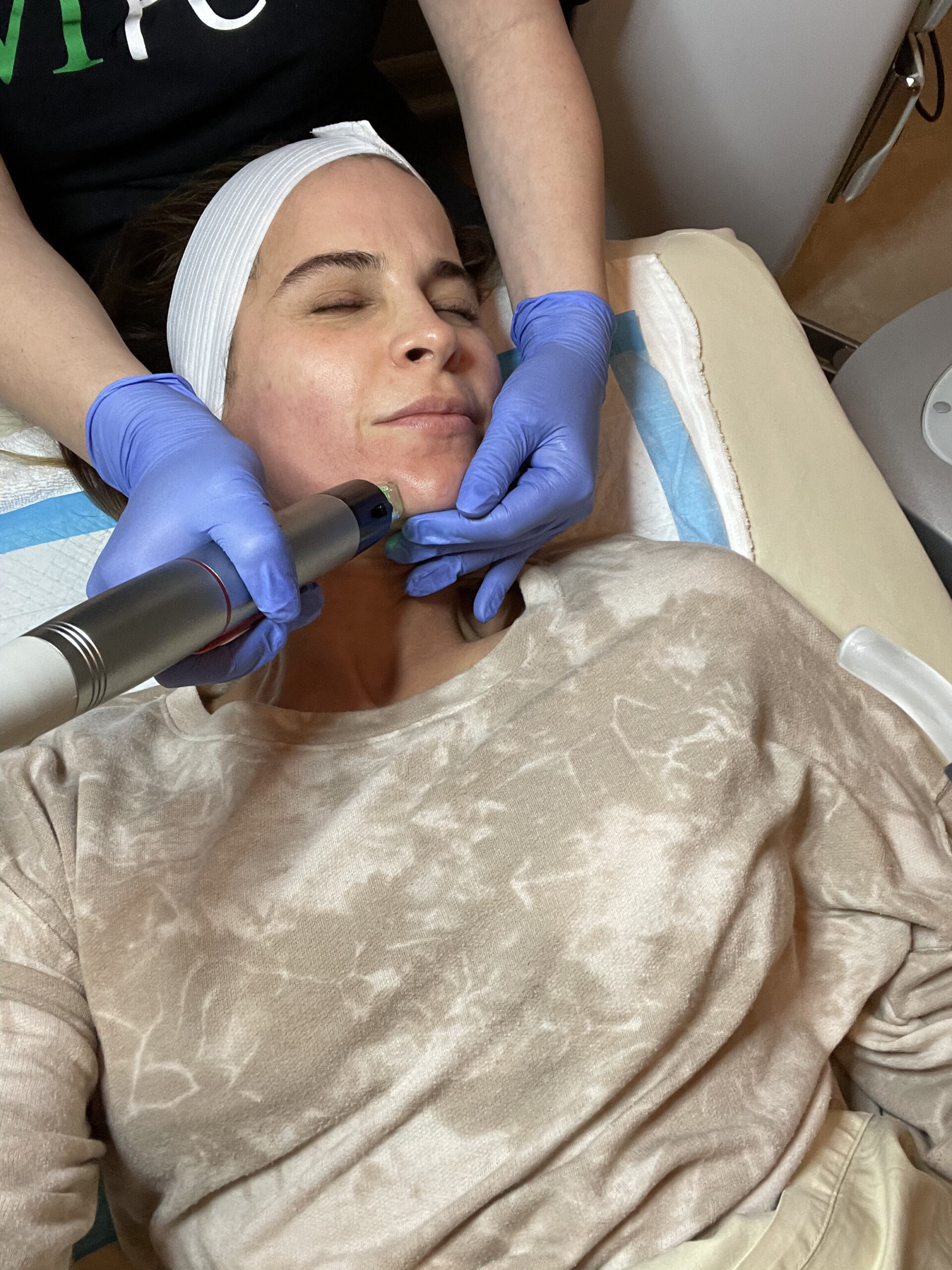 In the middle of the RF microneedling process. The expression is genuine.